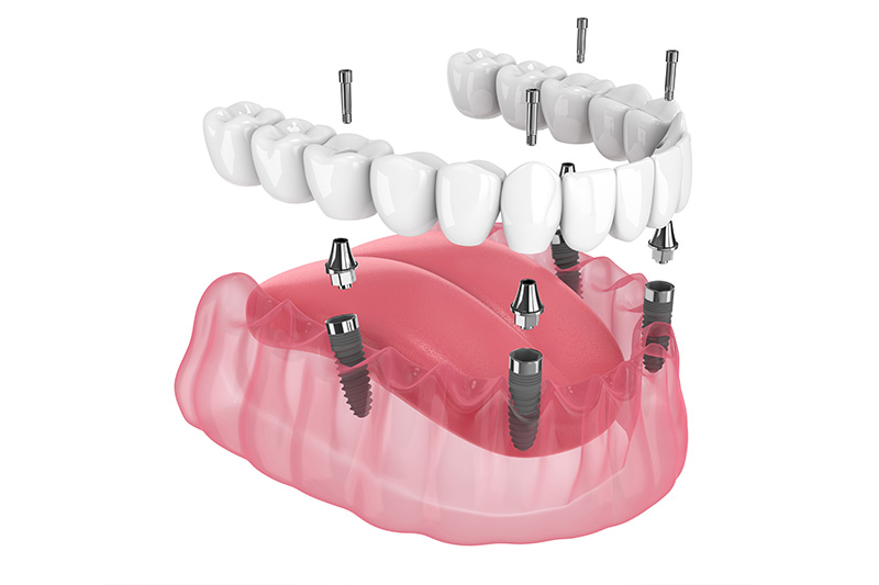 All-on-X Dental Implants in Matawan