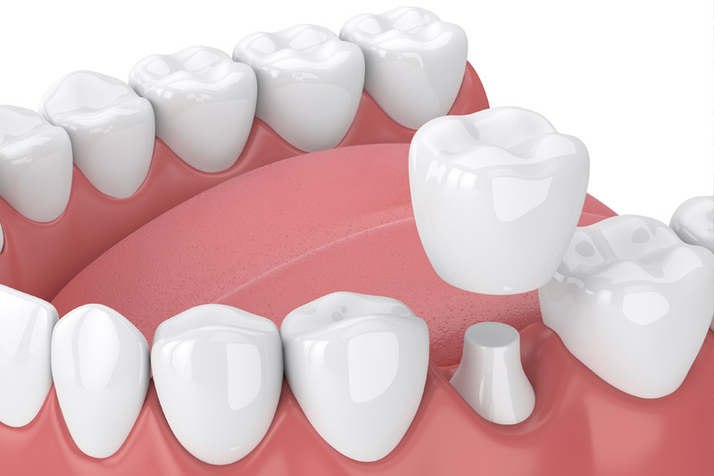 crowns Dental Crowns in Matawan
